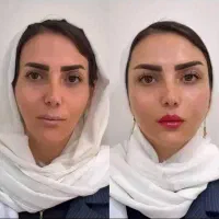 تزریق تخصصی فیلر، بوتاکس، ژل ، مطب زیبایی|خدمات زیبایی و سلامت|شیراز, سینما سعدی|دیوار