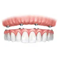 دندانپزشک به روش اوردنچر