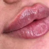 فیلر و بوتاکس وجوانساز