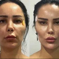 بلفاروپلاستی/کرمانشاه/ ۱۲ تومن/جراح فک و صورت