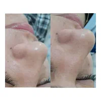 پاکسازی و فیشیال تخصصی پوست
