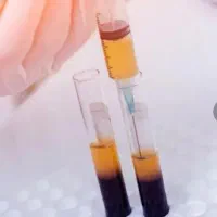 تخفیف پی آر پی prp پی ار پی سر و صورت