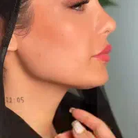 عمل بینی|خدمات آرایشگری و زیبایی|محمدشهر, محمدشهر|دیوار