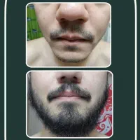 رویش ریش سبیل