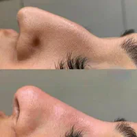 جشنواره تزریق ژل بوتاکس فیلر پی آرپی مطب زیبایی|خدمات آرایشگری و زیبایی|تبریز, |دیوار