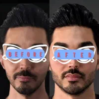 تزریقات ژل بوتاکس مزوتراپی