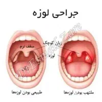 راهنمایی عمل لوزه