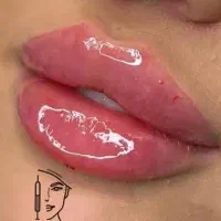 تزریق ژل و بوتاکس تضمینی