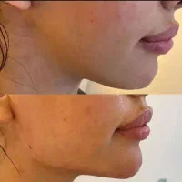 ژل بوتاکس و انزیم|خدمات آرایشگری و زیبایی|شیراز, لشکری‎|دیوار