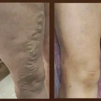 درمان تخصصی واریس