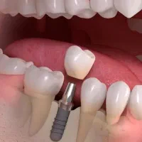 دندانپزشکی/ایمپلنت/شرایط اقساط بدون کارمزد