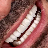 دندان مصنوعی تحویل( ۵ساعته)،کامپوزیت دندان ، روکش