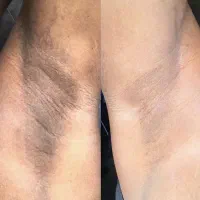خدمات لیزر و رفع تیرگی و لاغری باتخفیف ویژه|خدمات آرایشگری و زیبایی|بجنورد, |دیوار
