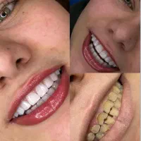 کامپوزیت ونیر آلمانی|خدمات آرایشگری و زیبایی|تهران, چیذر|دیوار