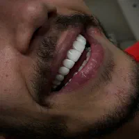 کامپوزیت دندان|خدمات آرایشگری و زیبایی|تهران, سلسبیل شمالی|دیوار