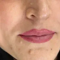 برداشتن انواع خال و لک و کک و مک|خدمات آرایشگری و زیبایی|نورآباد, |دیوار