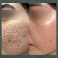 رفع جوش جای جوش جای لک