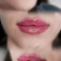 تخفیف بوتاکس، فیلر و کانتورینگ به مدت محدود