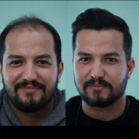 کاشت مو / کاشت ابرو /