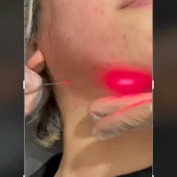 افر اندولیفت اقساط توسط پزشک با دستگاه اصل