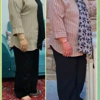 بوتاکس معده