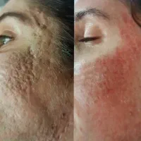 خدمات تخصصی پوست|خدمات آرایشگری و زیبایی|کرج, کوی کارمندان جنوبی|دیوار