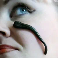 زالو درمانی