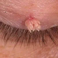 مرکز تخصصی برداشتن خال و زگیل ، اچ پی وی