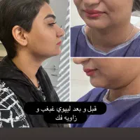 جشنواره پاییزه بوتاکس و فیلر و لیزر با تخفیف۳۰درصد|خدمات آرایشگری و زیبایی|اصفهان, فیض|دیوار