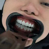 دندانپزشکی کامپوزیت روکش عصب کشی و ترمیم