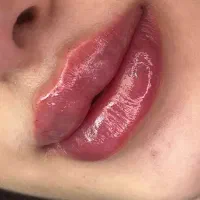 تزریق ژل و بوتاکس|خدمات آرایشگری و زیبایی|بروجرد, |دیوار