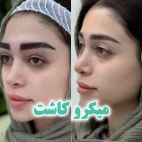 کاشت مو و ابرو