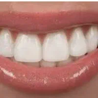 دندانسازی و روکش ندان پرکردن