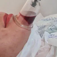 حجامت بادکش گرم و زالو حرفه ای