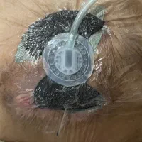 پانسمان نوین زخم بستر / دیابتی / سوختگی / سرطانی|خدمات آرایشگری و زیبایی|ارومیه, |دیوار