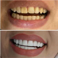 کامپوزیت دندان لمینت سرامیک عصب کشی/میدان جمهوری|خدمات آرایشگری و زیبایی|تهران, آذربایجان|دیوار