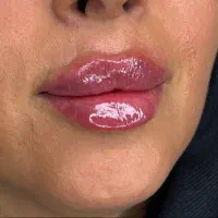 تزریق ژل  بوتاکس  فیلر  پرسینگ|خدمات آرایشگری و زیبایی|قم, نیروگاه|دیوار