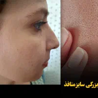 آف مزوتراپی و مزونیدلینگ|خدمات آرایشگری و زیبایی|اهواز, گلستان|دیوار