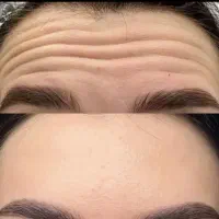 ژل وبوتاکس بابهترین کیفیت ومناسبترین قیمت