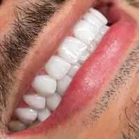 کامپوزیت زیبایی دندان، لمینت، روکش  زیرکونیا|خدمات آرایشگری و زیبایی|کرمانشاه, |دیوار