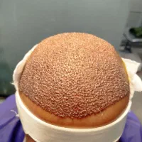 کاشت مو و ابرو(مزو/prp)