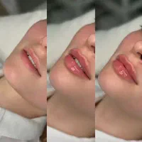 مدل تزریق ژل لب و صورت تزریق توسط پزشک