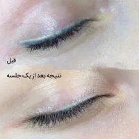 ریموو و پاک کردن تخصصی تاتو توسط مستر ریموو|خدمات آرایشگری و زیبایی|تهران, دهکده المپیک|دیوار