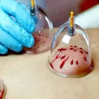 حجامت بهداشتی و سلامت کل بدن