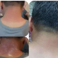 ترمیم زخم سوختگی|آرایشی، بهداشتی، درمانی|قم, حنیف نژاد|دیوار