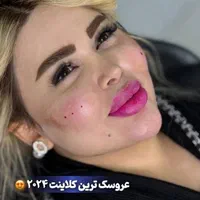 تزریق ژل،بوتاکس،فیلر،مزوتراپی،پی آر پی لیزر  هایفو|خدمات آرایشگری و زیبایی|اردبیل, |دیوار