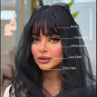 تخفیف ویژه پایان فصل/ژل،بوتاکس