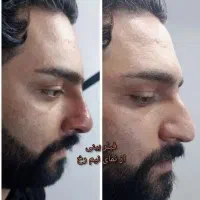 لیفت کامل بینی(اواتار) بدون جراحی به روش (NOA)|خدمات زیبایی و سلامت|مشهد, سناباد|دیوار