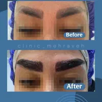 کاشت ویژه و تخصصی مو و ابرو|خدمات آرایشگری و زیبایی|تهران, دزاشیب|دیوار