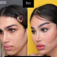 تزریق بوتاکس و لیفت چشم گربه ای  جدیدترین متد|خدمات آرایشگری و زیبایی|ری, دیلمان|دیوار